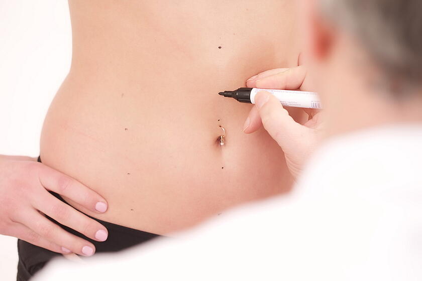Arzt zeichnet mit einem Stift auf dem Bauch einer Dame ein 